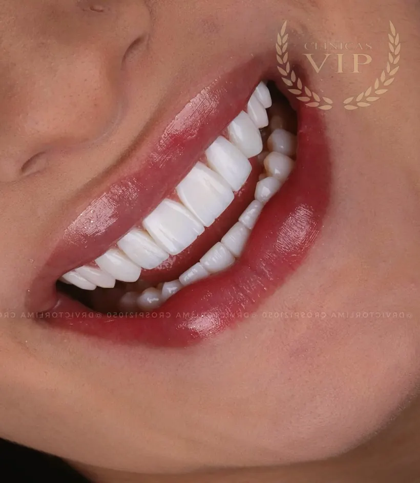 Detalhe de sorriso com lentes de resina